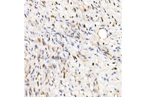 Immunohistochemistry of paraffin-embedded Human epithelioid sarcoma (ini-1 deletion) using SM/SNF5 Rabbit pAb  at dilution of 1:250 (40x lens). (SMARCB1 Antikörper  (AA 77-376))
