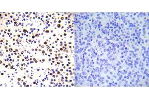 Immunohistochemical analysis of paraffin-embedded human malignant lymphoma tissue using Histone H3. (Histone H3.1 Antikörper  (pThr3))