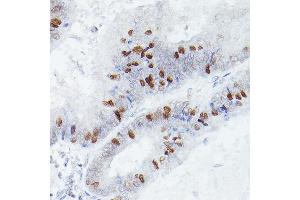 Immunohistochemistry of paraffin-embedded human colon carcinoma using RBPJK Rabbit mAb (ABIN1682563, ABIN3018511, ABIN3018512 and ABIN7101620) at dilution of 1:50 (40x lens). (RBPJ Antikörper)