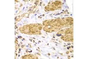 Immunohistochemistry of paraffin-embedded human gastric cancer using PTK2 antibody (ABIN5971141) at dilution of 1/100 (40x lens). (FAK Antikörper)