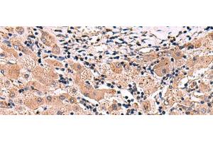 Immunohistochemistry of paraffin-embedded Human liver cancer tissue using INSC Polyclonal Antibody at dilution of 1:65(x200) (INSC Antikörper)