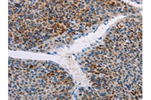 The image on the left is immunohistochemistry of paraffin-embedded Human liver cancer tissue using ABIN7128388(AMOTL2 Antibody) at dilution 1/20, on the right is treated with fusion protein. (AMOTL2 Antikörper)