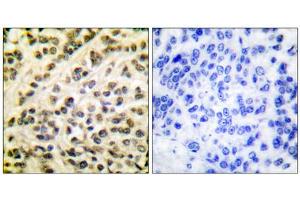 Immunohistochemical analysis of paraffin-embedded human breast carcinoma tissue, using FLI1 antibody (ABIN5976400). (FLI1 Antikörper  (Internal Region))