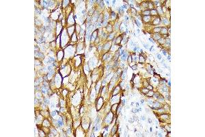 Immunohistochemistry of paraffin-embedded human esophageal cancer using Cytokeratin 6 (KRT6) (KRT6) Rabbit mAb (ABIN1680165, ABIN3019111, ABIN3019112 and ABIN7101717) at dilution of 1:100 (40x lens). (KRT6A Antikörper)