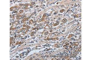 Immunohistochemistry of Human ovarian cancer using SLC34A2 Polyclonal Antibody at dilution of 1:50 (SLC34A2 Antikörper)