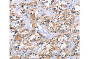 Immunohistochemistry of Human thyroid cancer using APOL6 Polyclonal Antibody at dilution of 1:50 (APOL6 Antikörper)