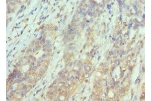 Immunohistochemistry of paraffin-embedded human endometrial cancer using ABIN7169126 at dilution of 1:100 (PAK1 Antikörper  (AA 1-240))