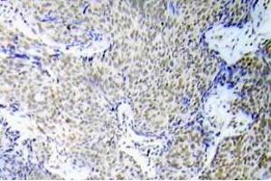 Immunohistochemistry (IHC) analyzes of p-GATA-1 antibody in paraffin-embedded human lung adenocarcinoma tissue. (GATA1 Antikörper  (pSer310))