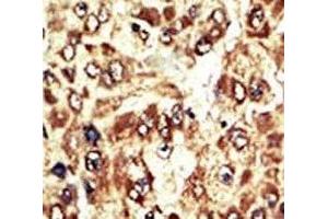 IHC analysis of FFPE human hepatocarcinoma tissue stained with the WEE1 antibody (WEE1 Antikörper  (AA 604-634))