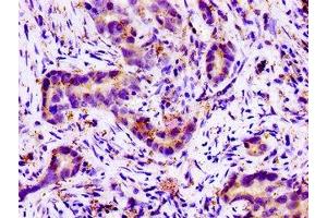 Immunohistochemistry of paraffin-embedded human pancreatic cancer using ABIN7161093 at dilution of 1:100 (SLC11A2 Antikörper  (AA 1-69))