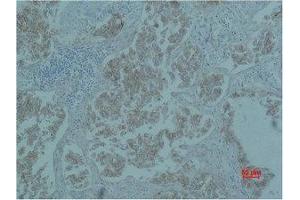 Immunohistochemistry (IHC) analysis of paraffin-embedded Human Lung Carcicnoma using Catenin-beta Monoclonal Antibody. (beta Catenin Antikörper)