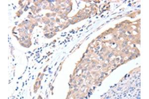 The image on the left is immunohistochemistry of paraffin-embedded Human breast cancer tissue using ABIN7128194(ACTL8 Antibody) at dilution 1/15, on the right is treated with fusion protein. (Actin-Like 8 Antikörper)