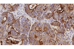 Human adenocarcinoma of endometrium: immunohistochemical staining on CA125. (MUC16 Antikörper)