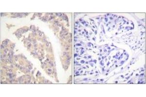 Immunohistochemistry analysis of paraffin-embedded human breast carcinoma tissue, using CBL (Ab-700) Antibody. (CBL Antikörper  (AA 666-715))