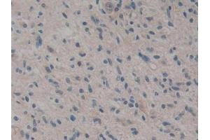 DAB staining on IHC-P; Samples: Human Glioma Tissue (CARD9 Antikörper  (AA 26-283))