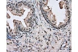 Immunohistochemical staining of paraffin-embedded Adenocarcinoma of colon tissue using anti-BSG mouse monoclonal antibody. (CD147 Antikörper)