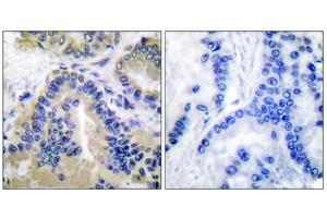 Immunohistochemical analysis of paraffin-embedded human lung carcinoma tissue, using Caspase 10 antibody. (Caspase 10 Antikörper  (C-Term))