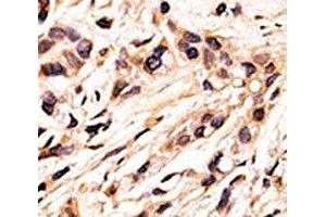 IHC analysis of FFPE human breast carcinoma tissue stained with the phospho-Rb antibody. (Retinoblastoma Protein (Rb) Antikörper  (pSer608))