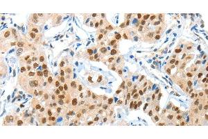 Immunohistochemistry of paraffin-embedded Human lung cancer using APPL1 Polyclonal Antibody at dilution of 1:70 (APPL1 Antikörper)