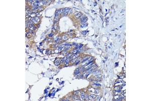 Immunohistochemistry of paraffin-embedded human colon carcinoma using PKC alpha antibody (ABIN6128460, ABIN6135858, ABIN6135859 and ABIN7101370) at dilution of 1:100 (40x lens). (PKC alpha Antikörper)