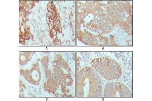 Immunohistochemical analysis of paraffin-embedded human breast carcinoma (A), hepatocarcinoma (B), stomach cancer (C) and colon cancer tissue (D), showing cytoplasmic location with DAB staining using CK18 antibody. (Cytokeratin 18 Antikörper  (AA 391-483))