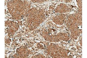 Immunohistochemistry analysis using Rabbit Anti-ROR1 Polyclonal Antibody (ABIN5667778). (ROR1 Antikörper  (AA 200-300) (APC))