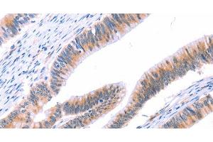 Immunohistochemistry of paraffin-embedded Human colon cancer tissue using VWF Polyclonal Antibody at dilution 1:50 (VWF Antikörper)