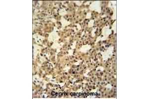 C Antibody (N-term) (ABIN650926 and ABIN2839997) immunohistochemistry analysis in formalin fixed and paraffin embedded human cervix carcinoma tissue followed by peroxidase conjugation of the secondary antibody and DAB staining. (CJ119 (AA 143-171), (N-Term) Antikörper)