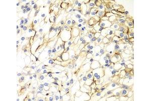 Immunohistochemistry of paraffin-embedded Human kidney cancer using VANGL2 Polyclonal Antibody at dilution of 1:100 (40x lens). (VANGL2 Antikörper)