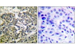 Immunohistochemistry analysis of paraffin-embedded human breast carcinoma, using AMPK alpha (Phospho-Thr172) Antibody. (AMPK alpha Antikörper  (pThr183))