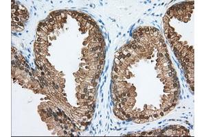 Immunohistochemical staining of paraffin-embedded Adenocarcinoma of Human colon tissue using anti-ACAT2 mouse monoclonal antibody. (ACAT2 Antikörper)