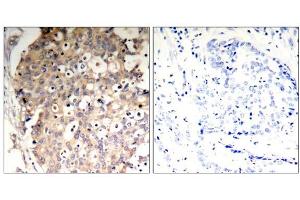 Immunohistochemical analysis of paraffin-embedded human breast carcinoma tissue, using SHP-1 (Phospho-Tyr536) Antibody (E011318). (SHP1 Antikörper  (pTyr536))
