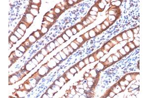 Formalin-fixed, paraffin-embedded human Small Intestinal Carcinoma stained with Villin-Monospecific Recombinant Mouse Monoclonal Antibody (rVIL1/1325). (Rekombinanter Villin 1 Antikörper  (AA 179-311))