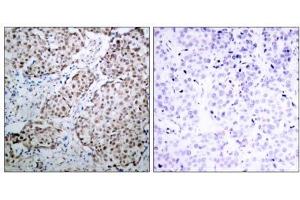 Immunohistochemical analysis of paraffin-embedded human breast carcinoma tissue using p53 (phospho- Ser315) antibody (E011100). (p53 Antikörper  (pSer315))