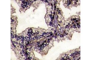 IHC analysis of FFPE prostate carcinoma tissue stained with Lactoferrin antibody. (Lactoferrin Antikörper  (AA 219-248))