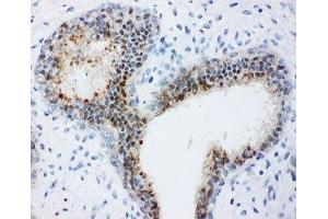 IHC-P: Bub3 antibody testing of human breast cancer tissue (BUB3 Antikörper  (Middle Region))