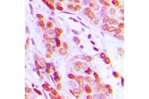 Immunohistochemical analysis of DAXX staining in human breast cancer formalin fixed paraffin embedded tissue section. (DAXX Antikörper  (C-Term))