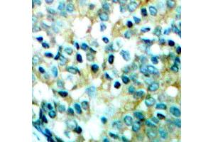 Immunohistochemistry of paraffin-embedded human breast carcinoma tissue, using Phospho-SRC-Y418 antibody (ABIN5969963). (Src Antikörper  (pTyr418))