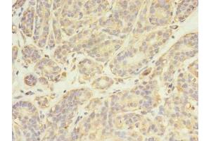 Immunohistochemistry of paraffin-embedded human breast cancer using ABIN7174025 at dilution of 1:100 (FYN Antikörper  (AA 154-270))