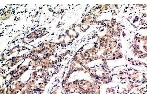 Immunohistochemistry of paraffin-embedded Human breast carcinoma tissue using Ubiquitin Monoclonal Antibody at dilution of 1:200. (Ubiquitin Antikörper)