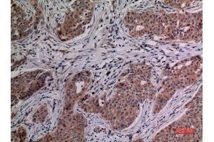 Immunohistochemical analysis of paraffin-embedded human-breast-cancer, antibody was diluted at 1:100. (IL-4 Antikörper  (Internal Region))