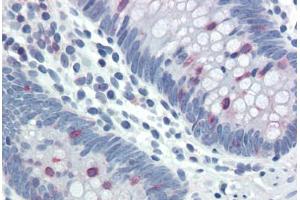 Human Colon (formalin-fixed, paraffin-embedded) stained with STAT5A/STAT5B antibody ABIN337157 at 20-40 ug/ml followed by biotinylated goat anti-rabbit IgG secondary antibody ABIN481713, alkaline phosphatase-streptavidin and chromogen. (STAT5 A/B Antikörper  (pTyr694))