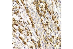 Immunohistochemistry of paraffin-embedded human stomach cancer using TACR3 antibody (ABIN5975101) at dilution of 1/100 (40x lens). (TACR3 Antikörper)