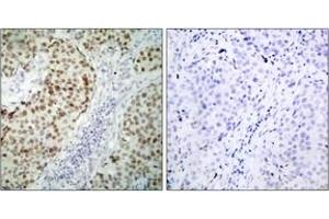 Immunohistochemistry (IHC) image for anti-Tumor Protein P53 (TP53) (AA 1-50) antibody (ABIN2889047) (p53 Antikörper  (AA 1-50))