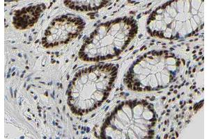 ABIN6267350 at 1/200 staining human colon carcinoma tissue sections by IHC-P. (Bcl-2 Antikörper  (pSer87))