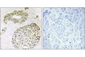 Immunohistochemistry analysis of paraffin-embedded human breast carcinoma tissue, using hnRNP M Antibody. (HNRNPM Antikörper  (AA 11-60))