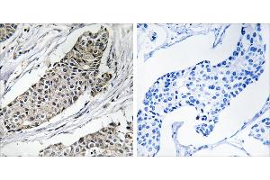Peptide - +Immunohistochemistry analysis of paraffin-embedded human breast carcinoma tissue using KCNAB3 antibody. (KCNAB3 Antikörper  (C-Term))
