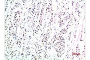 Immunohistochemical analysis of paraffin-embedded Human Stomach Carcinoma Tissue using Phospho-Smad3(S425) Mouse mAb diluted at 1:200. (Phospho-SMAD3(S425) (pSer425) Antikörper)