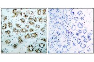 Immunohistochemical analysis of paraffin-embedded human breast carcinoma tissue, using NFκB-p65 (phospho-Ser311) antibody (E011260). (NF-kB p65 Antikörper  (pSer311))