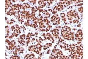 IHC testing of FFPE human prostate carcinoma with FOXA1 antibody (clone FOXA1/1512). (FOXA1 Antikörper  (AA 372-472))